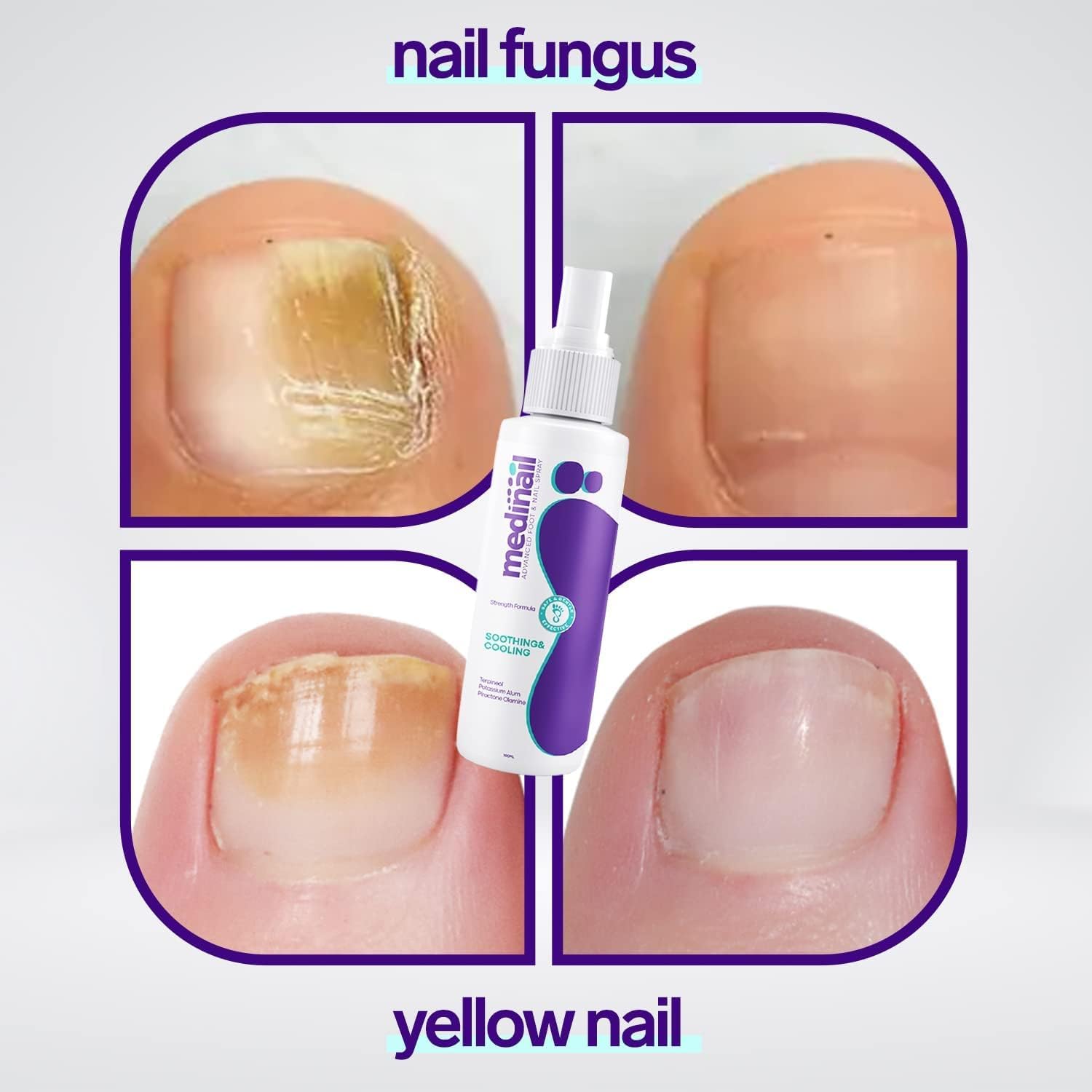 Medinal Nail Fungus Spray Fast Natural Treatment for Fungal Infections & Yellow Nails
