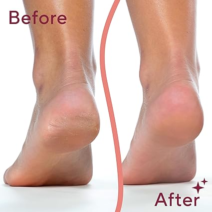 Electric Foot Callus Remover Smooth & Soft Feet Instantly
